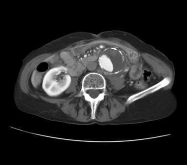Contrast-enhanced abdominal CT in an elderly patie
