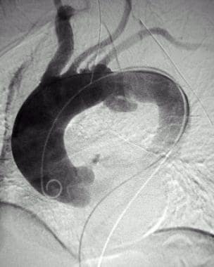 Digital subtraction catheter aortogram (early phas