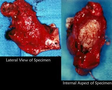 The patient was advised that biopsy of cystic lesi