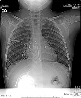 Novel pacemaker implantable cardioverter/defibrill