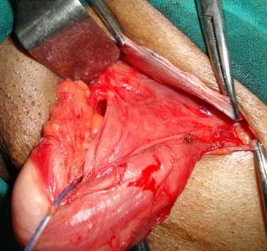 Open inguinal hernia repair. Cord structures and h