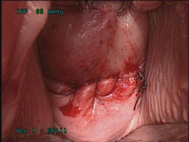 Transvaginal cholecystectomy. Closure of culdotomy