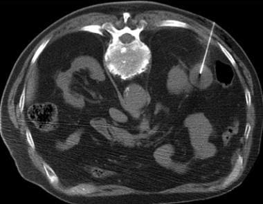 CT-guided biopsy of a renal mass.