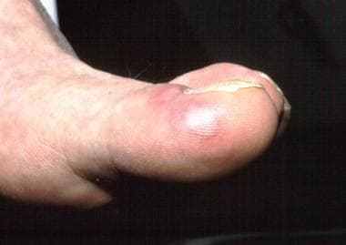 Close-up of great toe bulla. 