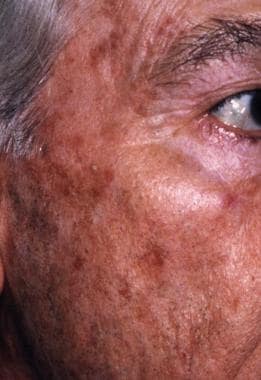 atrophic actinic keratosis