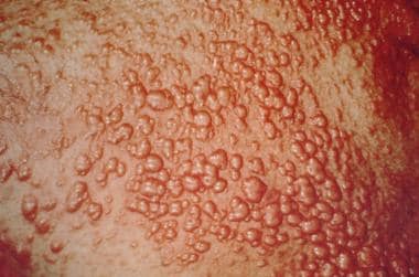 eruptive xanthomatosis