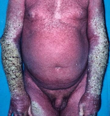 Crusted scabies. Courtesy of Kenneth E. Greer, MD.
