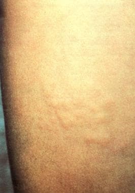 Plaque of grouped papular eruptions on the thigh. 