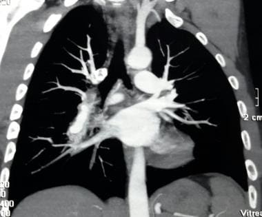 CT angiogram showing pulmonary artery aneurysm in 