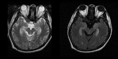 Paraneoplastic encephalomyelitis. 