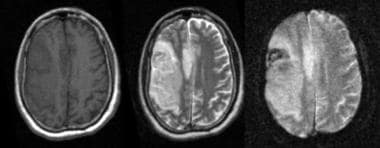 This MRI reveals hemorrhagic transformation of an 