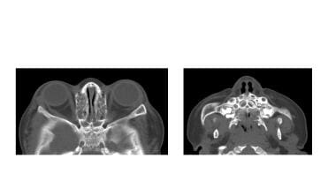 Axial facial CT scans in the same patient as in th