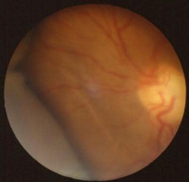 Choroidal Detachment Clinical Presentation: History, Physical, Causes