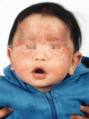 Typical atopic dermatitis on the face of an infant