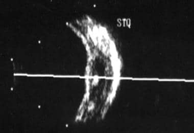 B-scan ocular ultrasonography demonstrating cystic