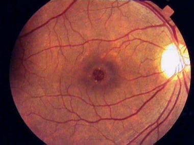 Full-thickness macular hole with typical yellowish