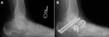 Radiographs of foot in patient with pes planus (fl