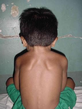Clinical photograph of a child with Sprengel defor