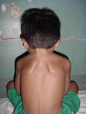 Sprengel Deformity (Congenital Elevation of Scapula) Clinical Presentation:  History and Physical Examination, Classification