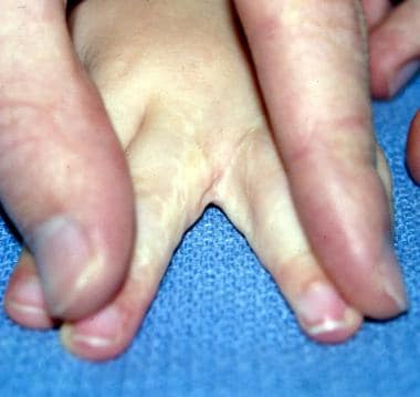 Hand of 26-month-old patient who underwent release
