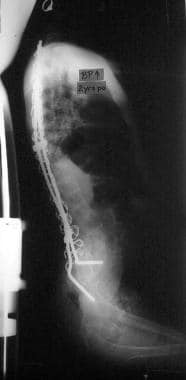Neuromuscular scoliosis. Postoperative lateral spi