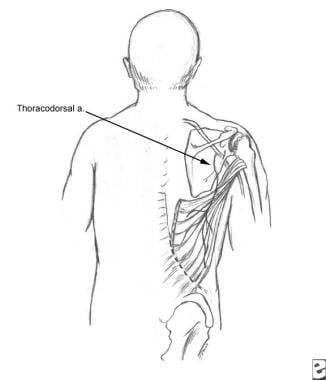 Latissimus dorsi can be used as an island flap to 