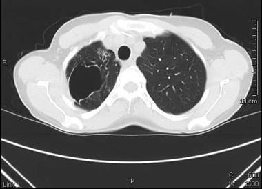 Recurrent pneumonias, particularly those due to S 