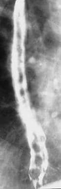 Barium swallow demonstrating esophageal varices in