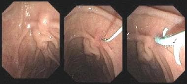 pancreatic pseudocyst drainage