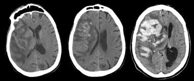 Noncontrast computed tomography scan (left) obtain