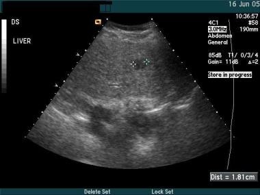 liver cancer ultrasound