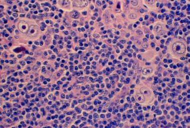 Mixed cellularity Hodgkin lymphoma showing both mo