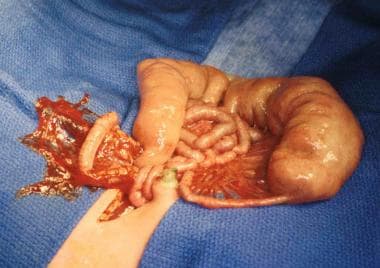 Intestinal obstruction in the newborn. Jejunal atr