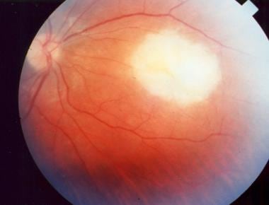 Acute macular retinitis associated with primary ac
