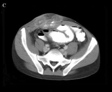 A right lower quadrant abdominal wall abscess and 