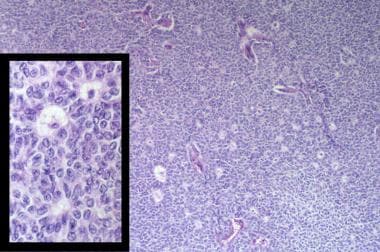 Microfollicular pattern of an adult granulosa cell