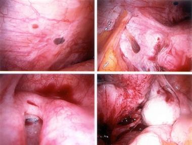 Endometriosis