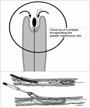 Treatments for varicose veins (IV): classic surgery / stripping