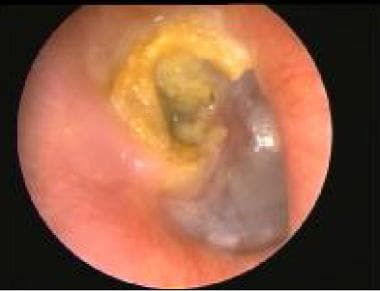 A cholesteatoma with a white mass can be seen behi