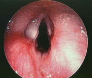 Postoperative close up view of the true vocal cord