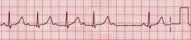 A common pattern of second-degree atrioventricular