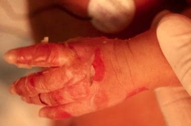 Ruptured bulla of the hand in a newborn with epide