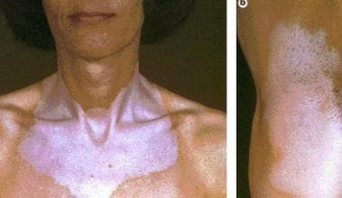 Left photograph shows vitiligo in a patient with a