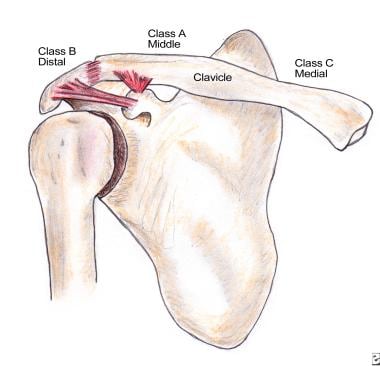 Anatomy of the clavicle indicating potential fract