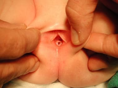 Pediatric imperforate anus (anorectal malformation