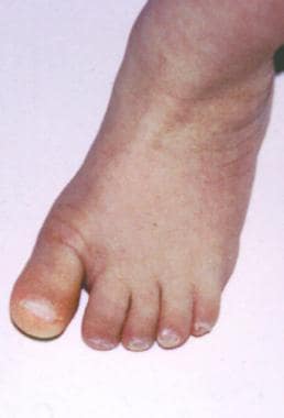 Wide gap between first and second toes and onychom