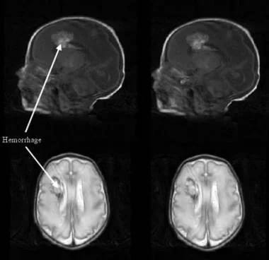 Periventricular hemorrhagic infarction (PVHI) on m