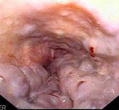 Large esophageal varices with red wale signs seen 
