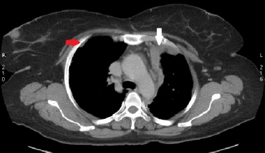 Axial slice from staging chest CT scan and biopsy 