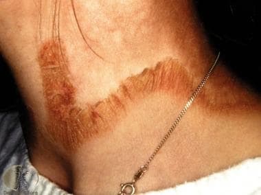 Pellagra lesions on the neck. Courtesy of DermNet 